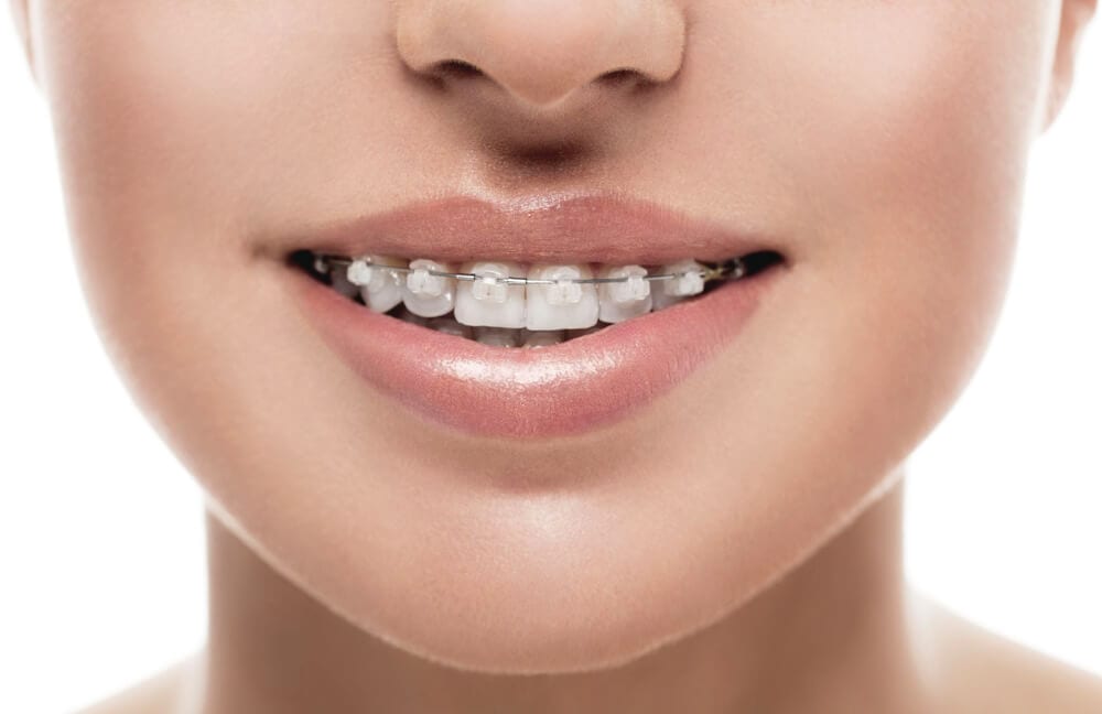 Brackets transparents | Vivortho - Centre d'orthodontie Paris