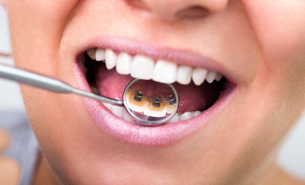 Aligner les dents à Paris chez un chirurgien dentiste